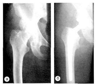 показанием к эндопротезированию тазобедренного сустава являются переломы