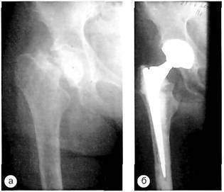 показанием к эндопротезированию тазобедренного сустава являются переломы