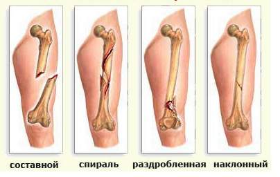 показания к оперативному лечению переломов у детей