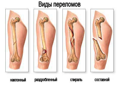 положение ноги при переломе малой берцовой кости