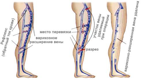 после флебэктомии нога внизу посинела и отекла что делать