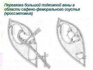 после флебэктомии нога внизу посинела и отекла что делать