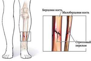 после перелома малой берцовой кости отекает нога