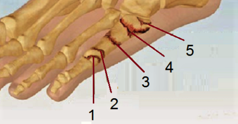 Перелом бугристости 5 плюсневой кости. Перелом 5 плюсневой кости Кост. Перелом плюсневой кости 5 фаланги ноги. Перелом плюсневой кости 5 пальца. Пластина в пальце