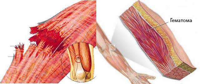 после ушиба руки гематома сильный отек и краснота чем лечить