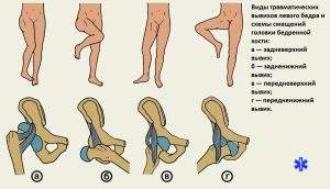 после вправления вывиха бедра проводится иммобилизация