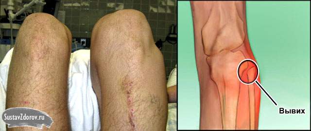 повреждение подколенной артерии при переднем вывихе в коленном суставе