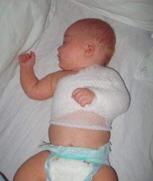 повязка дезо при переломе ключицы у новорожденного