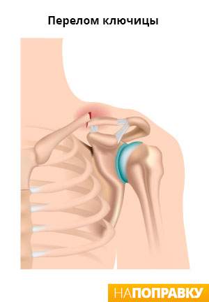 при переломе ключицы можно ли двигать рукой