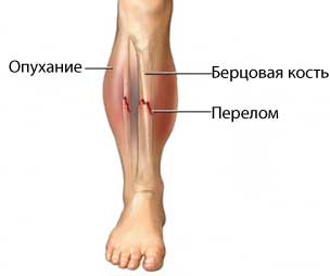 при переломе малой берцовой кости нужно зафиксировать