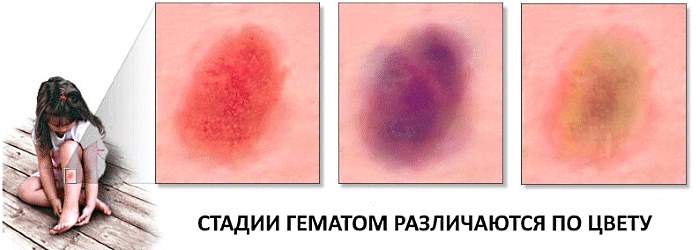 при ушибе и растяжении рекомендуется местно применить холод в течение