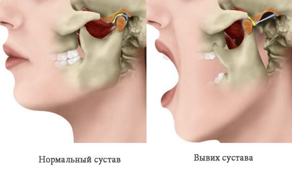 при вывихе челюсти к какому врачу обращаться