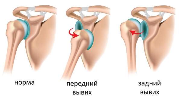 при вывихе сустава человеку до обращения к врачу необходимо