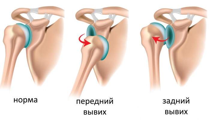 при вывихе в суставе суставная головка выходит из суставной впадины