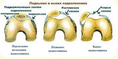 привычный вывих надколенника у ребенка 13 лет