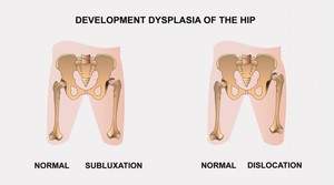 привычный вывих тазобедренного сустава у взрослых