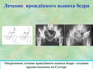 привычный вывих тазобедренного сустава у взрослых