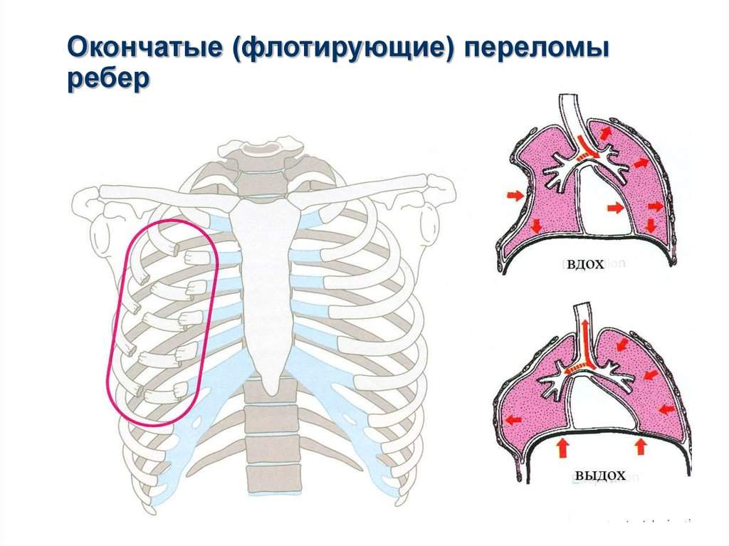 признаки перелома грудной клетки и первая помощь