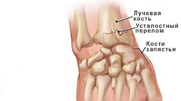 разработка лучезапястного сустава после перелома со смещением
