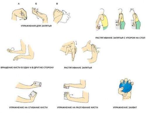 реабилитация после перелома руки после снятия гипса