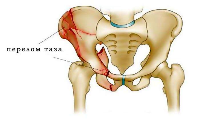 реабилитация после перелома таза после 6 месяцев