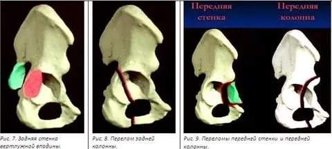 реабилитация после перелома вертлужной впадины без смещения