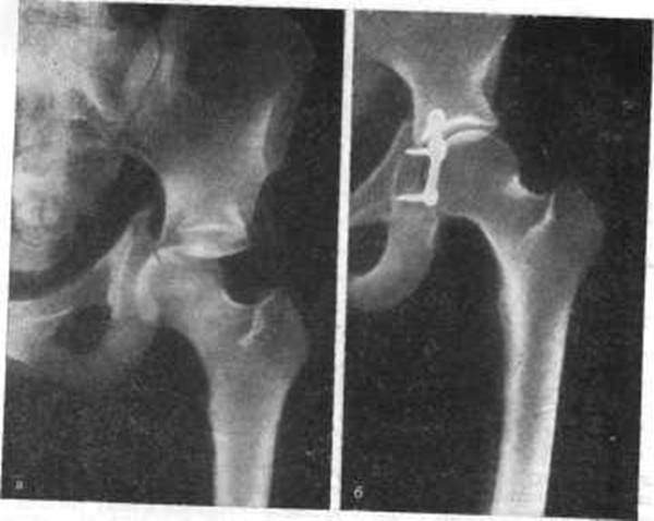 реабилитация после перелома вертлужной впадины без смещения