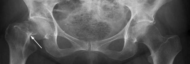 рентген при переломе шейки бедра на дому