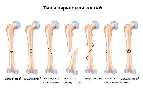 рентгенологические признаки переломов костей абсолютные и относительные