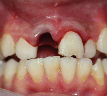реплантация зубов при полном вывихе у детей
