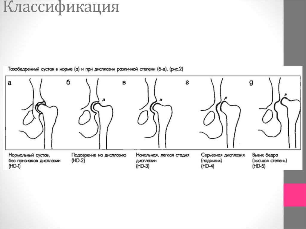 решающим симптомом в диагностике врожденного вывиха бедра является