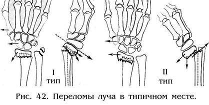 ротационные смещения при переломе костей предплечья зависят
