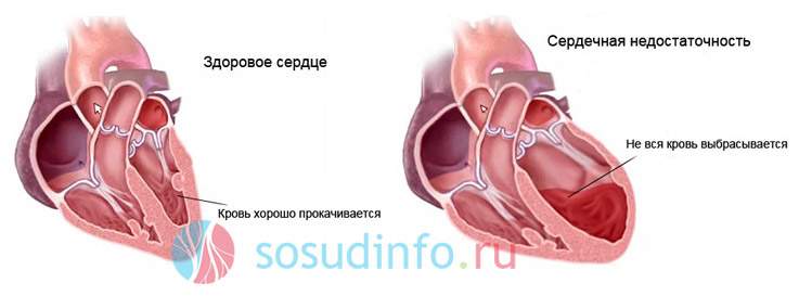 сердечная астма и отек легкого это формы острой недостаточности