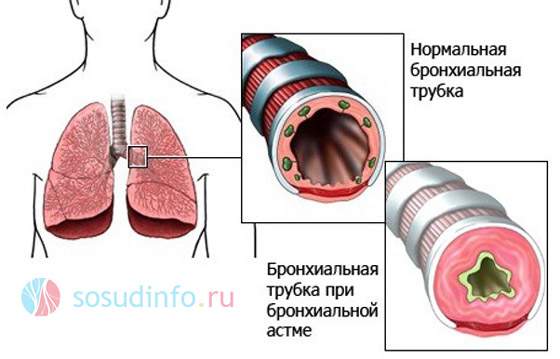 сердечная астма и отек легкого это формы острой недостаточности