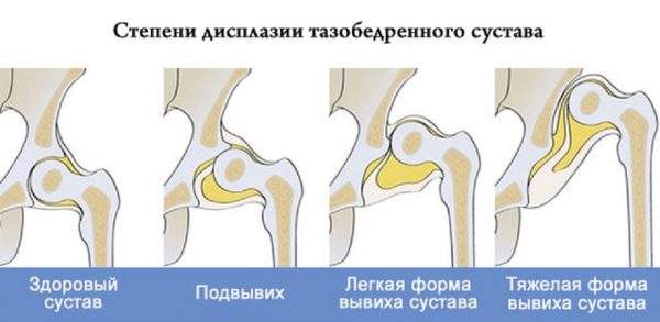 шина при вывихе тазобедренного сустава у детей