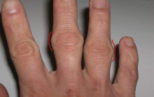 шишка на суставе пальца руки после ушиба