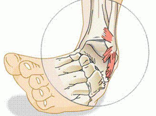 сильная боль при ходьбе после перелома лодыжки