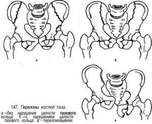 симптом прилипшей пятки характерен для перелома таза