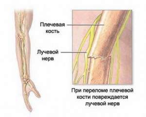 симптомы повреждения лучевого нерва при переломах плеча