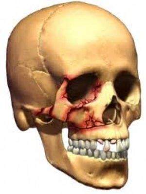 синоним перелома верхней челюсти по фор 3