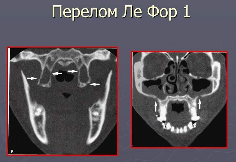 Перелом верхней челюсти картинки