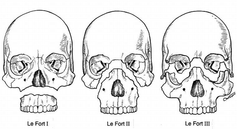 синоним перелома верхней челюсти по фор iii
