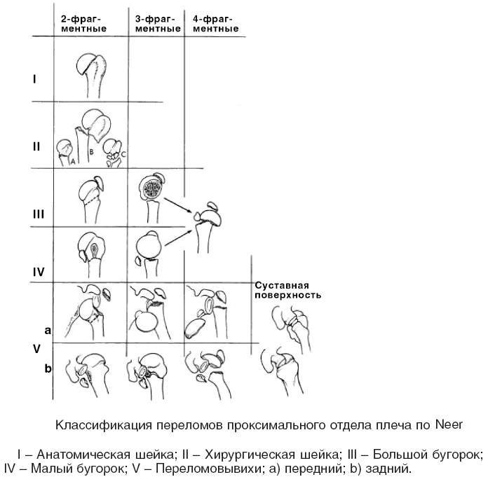 сколько болит рука после перелома плечевой кости