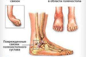 сколько ходить с тростью после перелома лодыжки