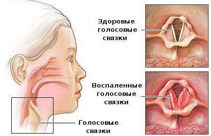 сколько лечится ларингит у взрослых без температуры с отеком связок