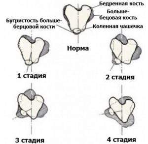 сколько носить гипс при вывихе коленного сустава