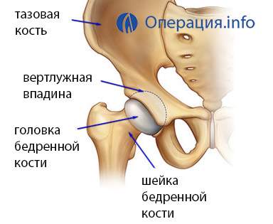 сколько стоит операция на бедро после перелома