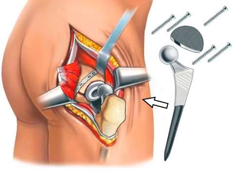 сколько стоят протезы при переломе шейки бедра