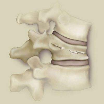 сколько времени болит спина после перелома позвоночника
