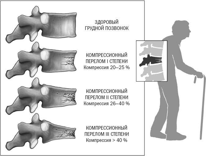 сколько времени болит спина после перелома позвоночника